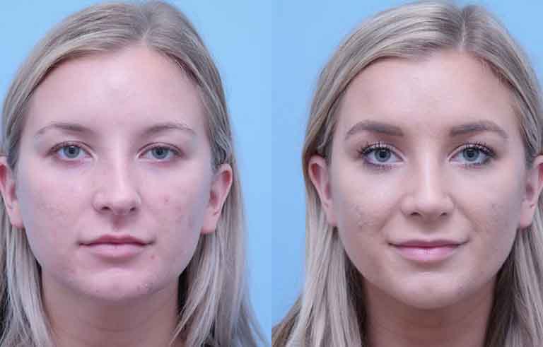 Rhinoplasty before and after photo by Midwest Facial Plastic Surgery in Minnesota