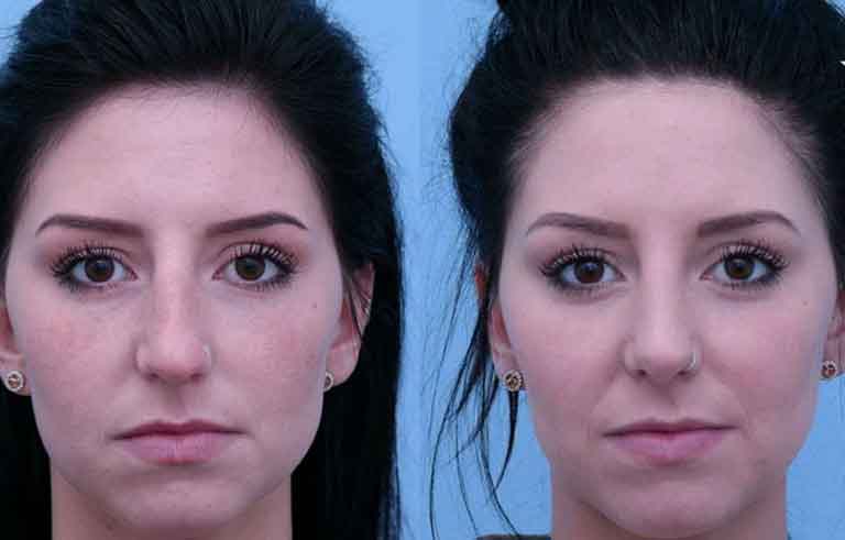 Rhinoplasty before and after photo by Midwest Facial Plastic Surgery in Minnesota