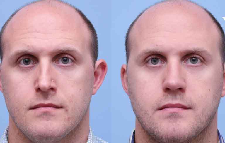 Rhinoplasty before and after photo by Midwest Facial Plastic Surgery in Minnesota