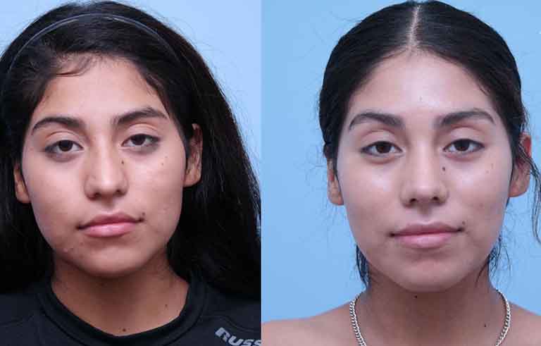 Rhinoplasty before and after photo by Midwest Facial Plastic Surgery in Minnesota