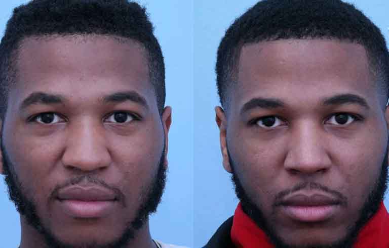 Rhinoplasty before and after photo by Midwest Facial Plastic Surgery in Minnesota