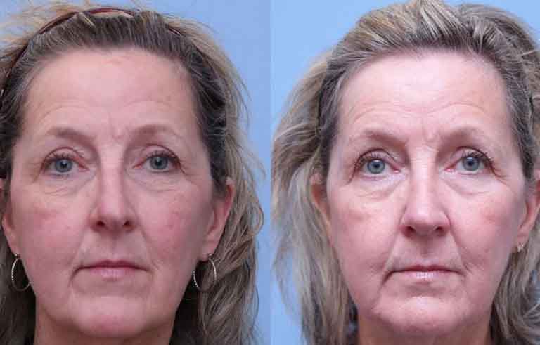 Rhinoplasty before and after photo by Midwest Facial Plastic Surgery in Minnesota