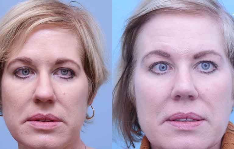 Rhinoplasty before and after photo by Midwest Facial Plastic Surgery in Minnesota