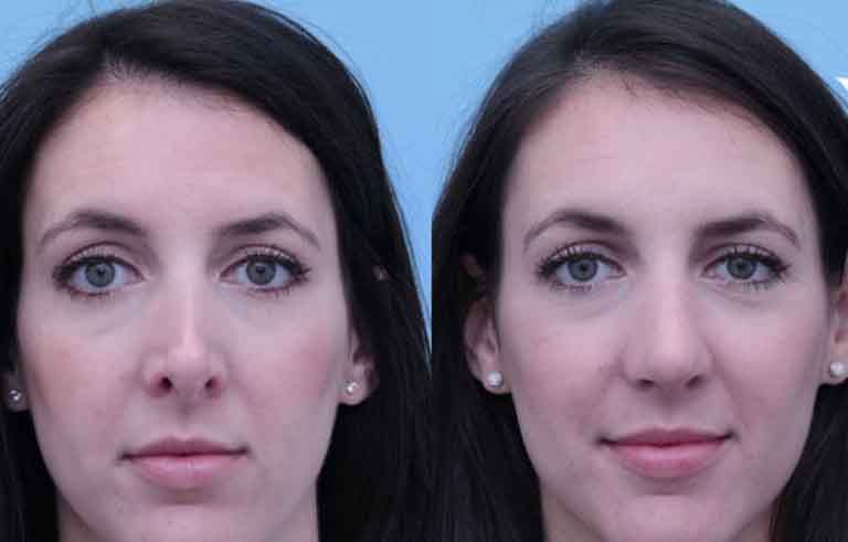 Rhinoplasty before and after photo by Midwest Facial Plastic Surgery in Minnesota