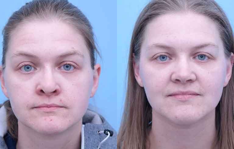 Rhinoplasty before and after photo by Midwest Facial Plastic Surgery in Minnesota
