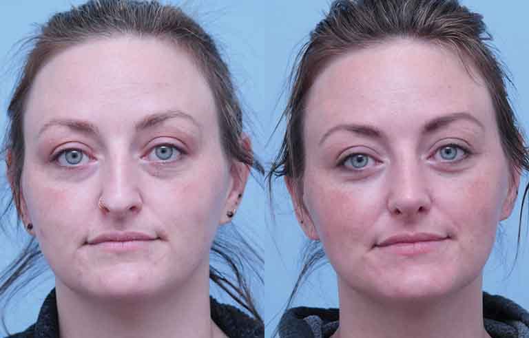 Rhinoplasty before and after photo by Midwest Facial Plastic Surgery in Minnesota