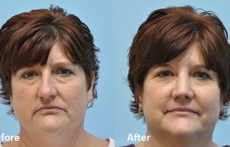 Rhinoplasty before and after photo by Midwest Facial Plastic Surgery in Minnesota
