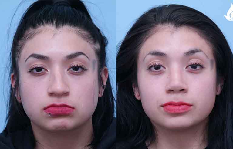 Rhinoplasty before and after photo by Midwest Facial Plastic Surgery in Minnesota