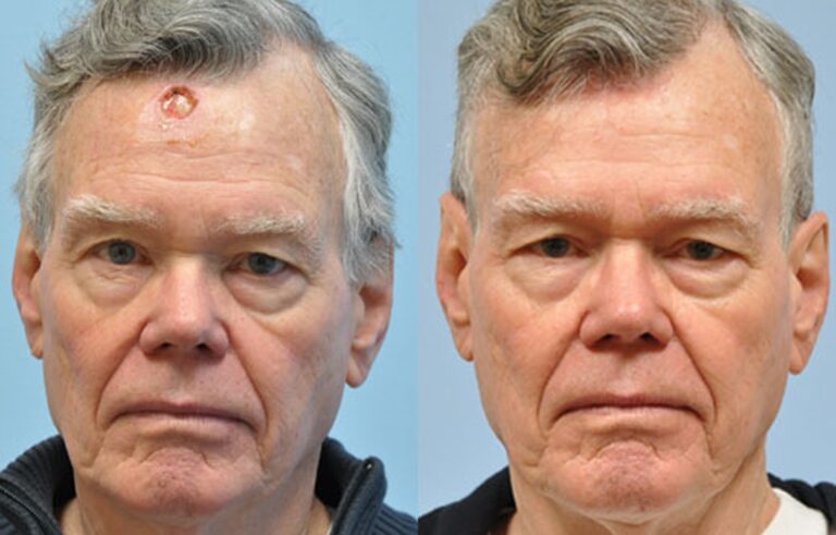 Mohs Reconstruction before and after photo by Midwest Facial Plastic Surgery in Minnesota