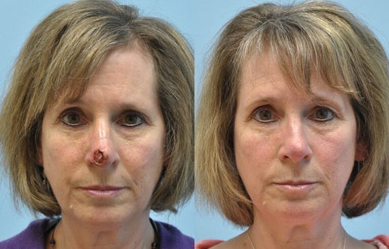 Mohs Reconstruction before and after photo by Midwest Facial Plastic Surgery in Minnesota