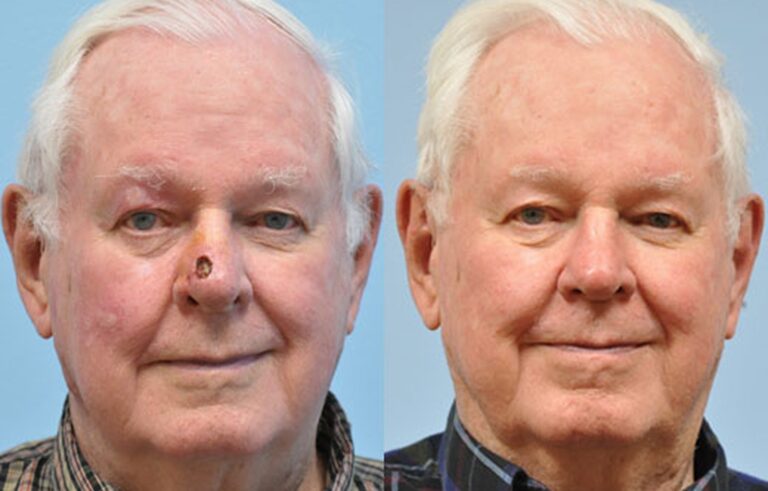 Mohs Reconstruction before and after photo by Midwest Facial Plastic Surgery in Minnesota