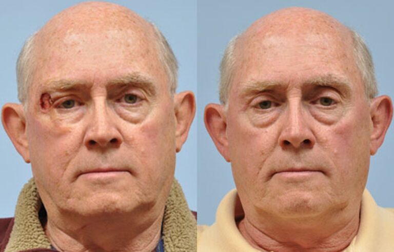Mohs Reconstruction before and after photo by Midwest Facial Plastic Surgery in Minnesota