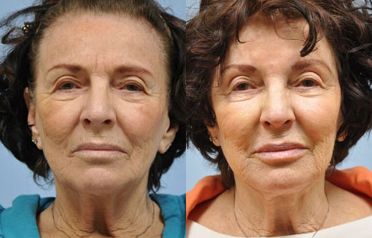 Injectable Fillers before and after photo by Midwest Facial Plastic Surgery in Minnesota