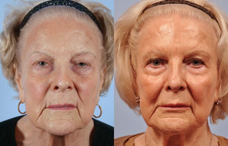 Injectable Fillers before and after photo by Midwest Facial Plastic Surgery in Minnesota