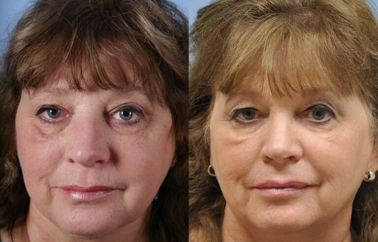 Injectable Fillers before and after photo by Midwest Facial Plastic Surgery in Minnesota