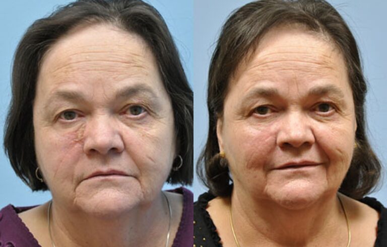 Laser Skin Resurfacing before and after photo by Midwest Facial Plastic Surgery in Minnesota