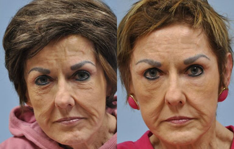Laser Skin Resurfacing before and after photo by Midwest Facial Plastic Surgery in Minnesota