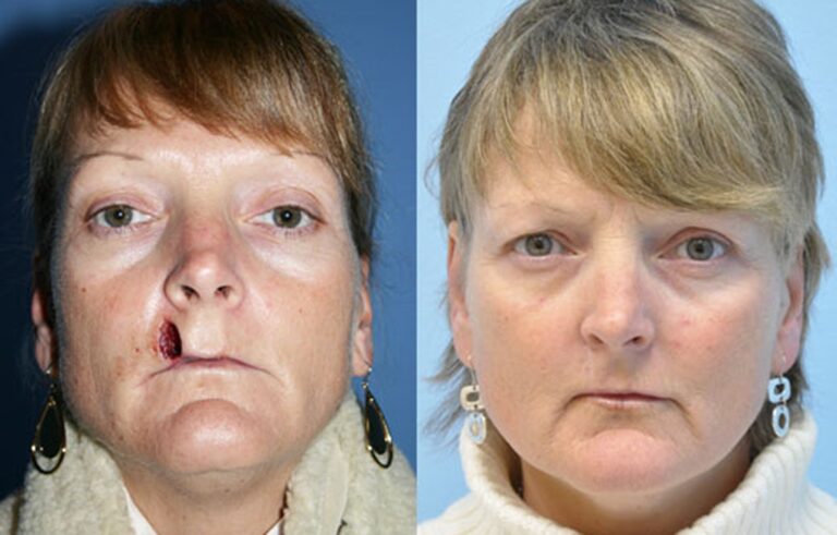 Lip Augmentation before and after photo by Midwest Facial Plastic Surgery in Minnesota