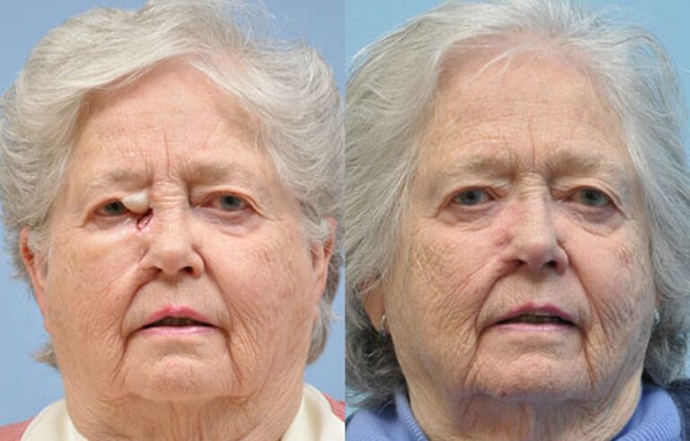 Mohs Reconstruction before and after photo by Midwest Facial Plastic Surgery in Minnesota