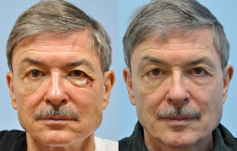 Mohs Reconstruction before and after photo by Midwest Facial Plastic Surgery in Minnesota