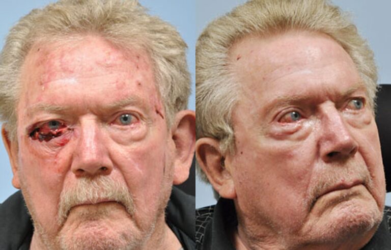 Mohs Reconstruction before and after photo by Midwest Facial Plastic Surgery in Minnesota