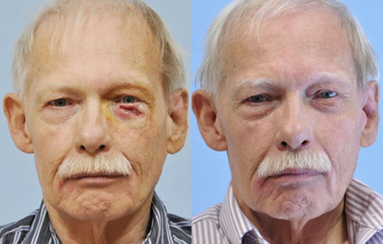 Mohs Reconstruction before and after photo by Midwest Facial Plastic Surgery in Minnesota