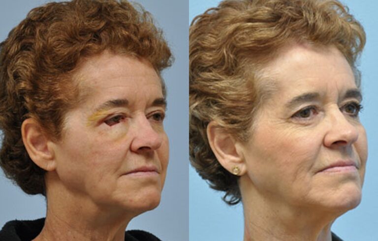 Mohs Reconstruction before and after photo by Midwest Facial Plastic Surgery in Minnesota