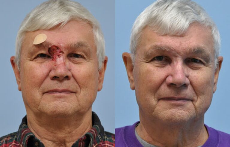 Mohs Reconstruction before and after photo by Midwest Facial Plastic Surgery in Minnesota