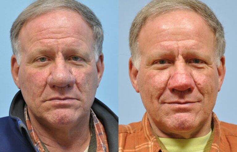 Laser Skin Resurfacing before and after photo by Midwest Facial Plastic Surgery in Minnesota