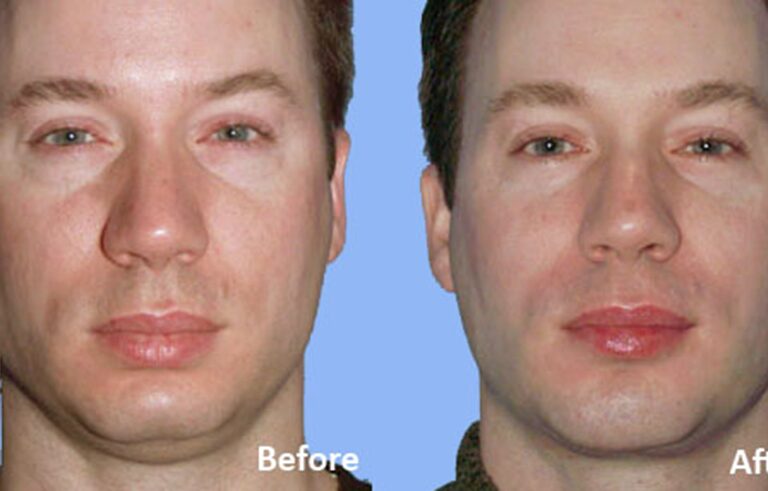 Facial Implants Chin Augmentation before and after photo by Midwest Facial Plastic Surgery in Minnesota