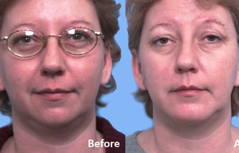 Facial Implants Chin Augmentation before and after photo by Midwest Facial Plastic Surgery in Minnesota