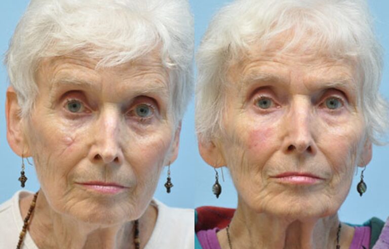 Laser Skin Resurfacing before and after photo by Midwest Facial Plastic Surgery in Minnesota