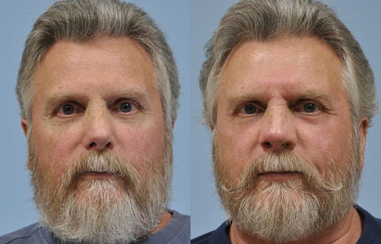 Laser Skin Resurfacing before and after photo by Midwest Facial Plastic Surgery in Minnesota