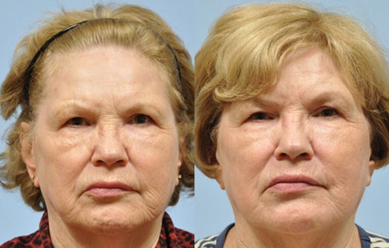 Laser Skin Resurfacing before and after photo by Midwest Facial Plastic Surgery in Minnesota