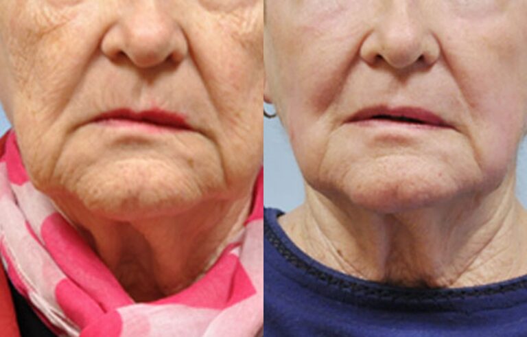 Laser Skin Resurfacing before and after photo by Midwest Facial Plastic Surgery in Minnesota