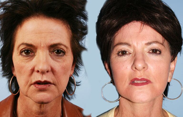 Laser Skin Resurfacing before and after photo by Midwest Facial Plastic Surgery in Minnesota
