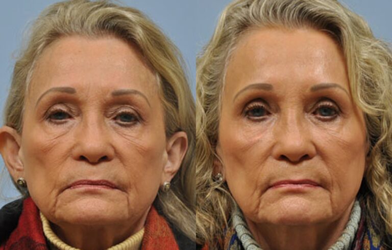 Injectable Fillers before and after photo by Midwest Facial Plastic Surgery in Minnesota