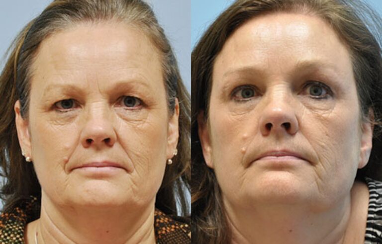 Eyelid Surgery before and after photo by Midwest Facial Plastic Surgery in Minnesota