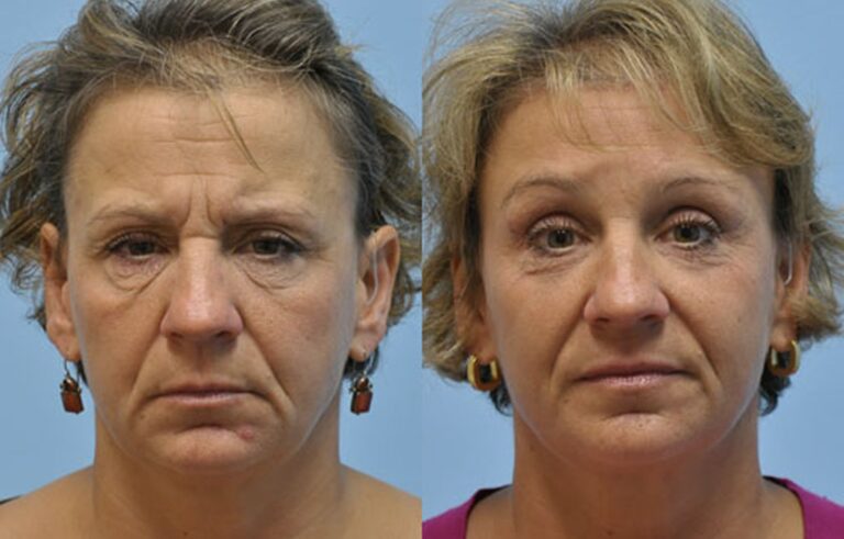 Eyelid Surgery before and after photo by Midwest Facial Plastic Surgery in Minnesota