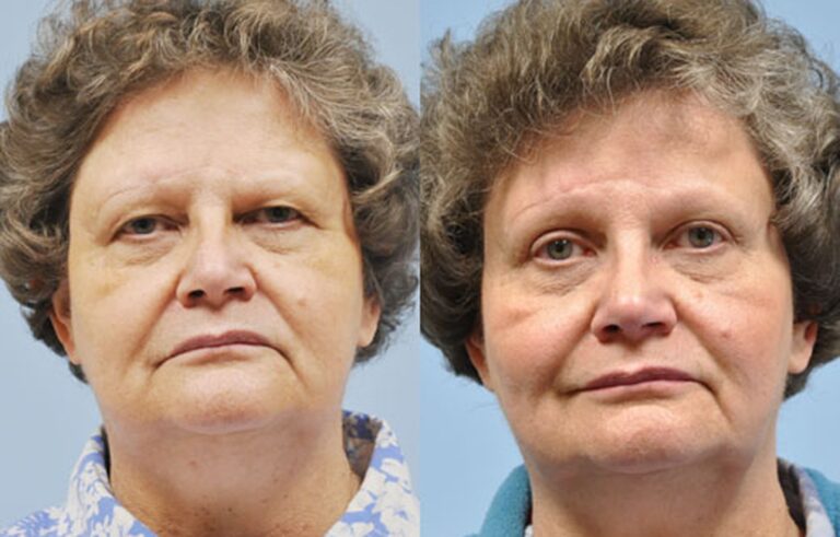 Eyelid Surgery before and after photo by Midwest Facial Plastic Surgery in Minnesota