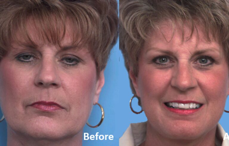 Facelift before and after photo by Midwest Facial Plastic Surgery in Minnesota