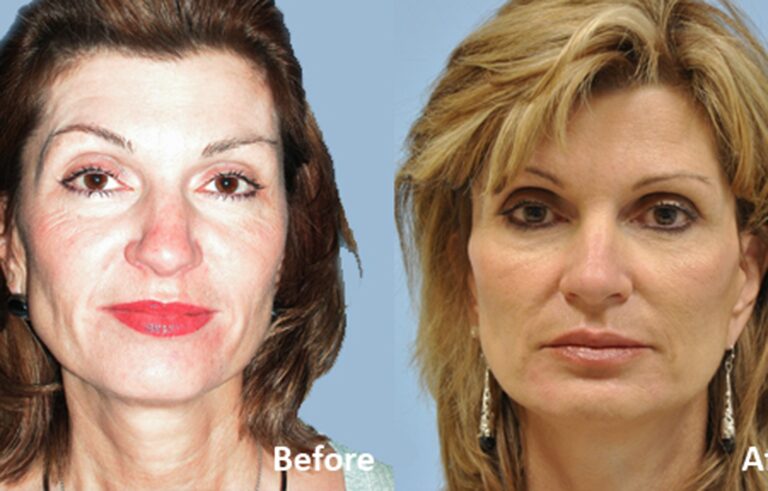 Facelift before and after photo by Midwest Facial Plastic Surgery in Minnesota