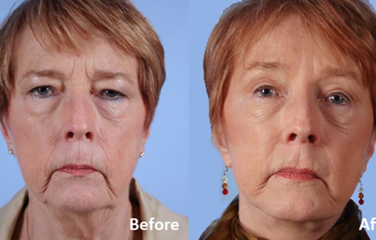 Facelift before and after photo by Midwest Facial Plastic Surgery in Minnesota