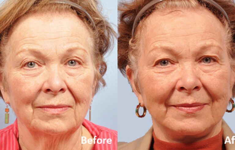Facelift before and after photo by Midwest Facial Plastic Surgery in Minnesota