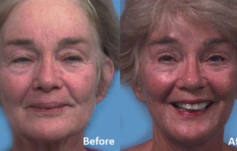 Facelift before and after photo by Midwest Facial Plastic Surgery in Minnesota