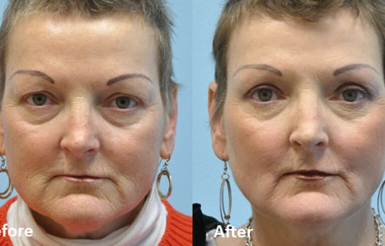 Laser Skin Resurfacing before and after photo by Midwest Facial Plastic Surgery in Minnesota