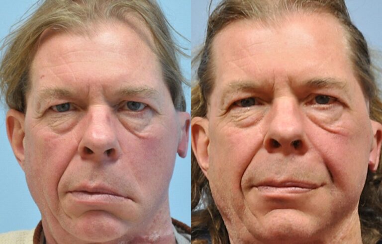 Facial Paralysis before and after photo by Midwest Facial Plastic Surgery in Minnesota