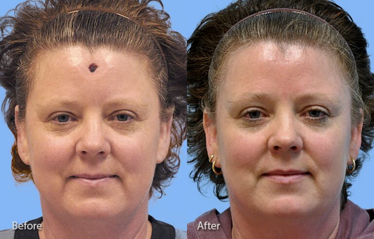 Mohs Reconstruction before and after photo by Midwest Facial Plastic Surgery in Minnesota x