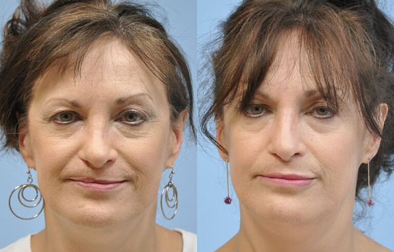 Lip Augmentation before and after photo by Midwest Facial Plastic Surgery in Minnesota