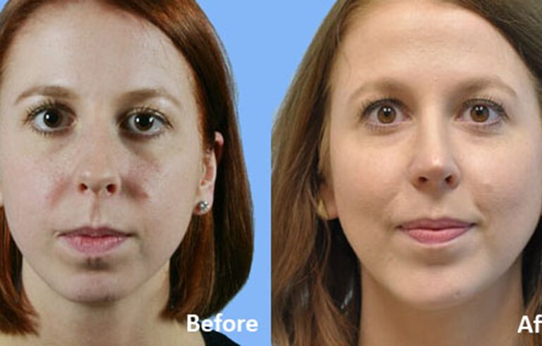 Facial Implants Chin Augmentation before and after photo by Midwest Facial Plastic Surgery in Minnesota
